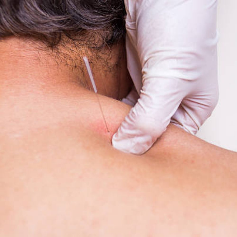 Dry needling at Kindred Bliss